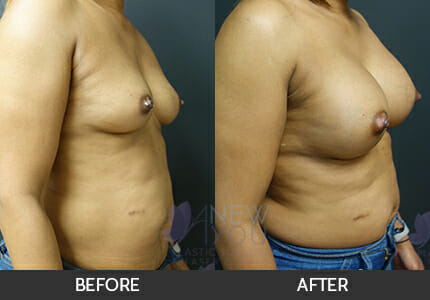 Breast Augmentation Gallery