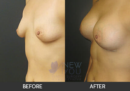 Breast Augmentation Gallery