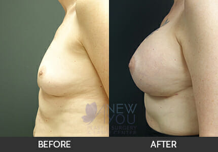 Breast Augmentation Gallery