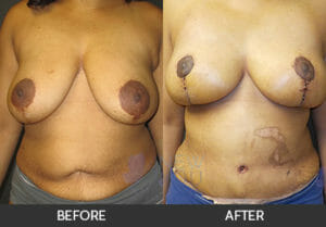 Breast Lift with Augmentation Before and After, Chicago, IL