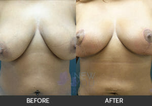 Breast Lift with Augmentation Before and After, Chicago, IL