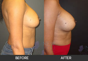 Breast Revision Before and After, Chicago, IL