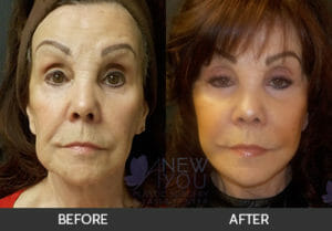 Female Facelift Before and After, Chicago, IL