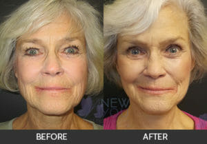 Female Facelift Before and After, Chicago, IL