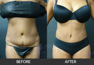Liposuction Before and After, Chicago, IL