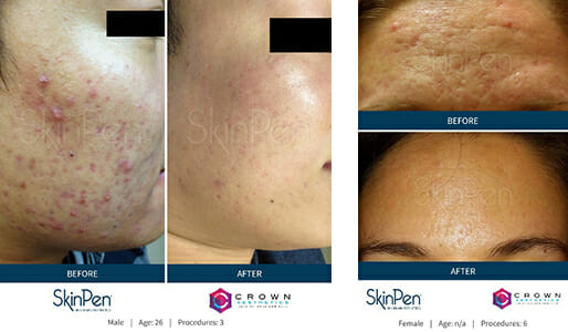 Microneedling Before and After Chicago
