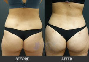 Brazilian Butt Lift Before and After, Chicago, IL