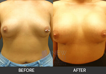 Breast Augmentation Gallery