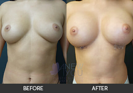 Breast Augmentation Gallery