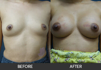 Breast Augmentation Gallery