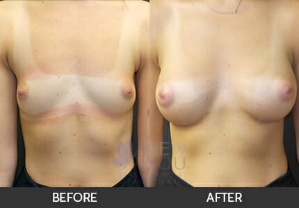 Breast Augmentation Gallery