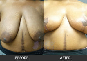 Breast Lift with Augmentation Before and After, Chicago, IL