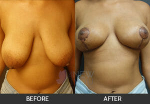 Breast Lift Before and After, Chicago, IL