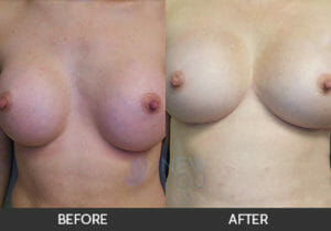 Breast Revision Before and After, Chicago, IL