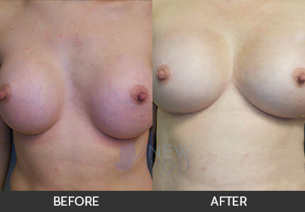 Breast Revision Gallery