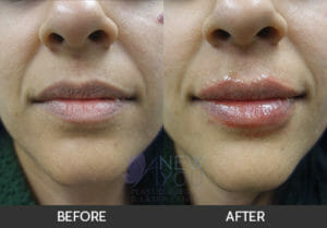 Lip Augmentation Before and After - Chicago, IL