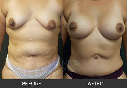 Breast Augmentation Gallery