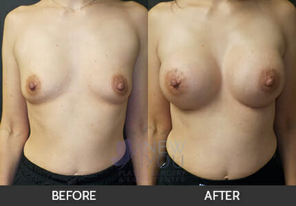 Breast Augmentation Gallery