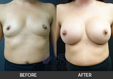 Breast Augmentation Gallery