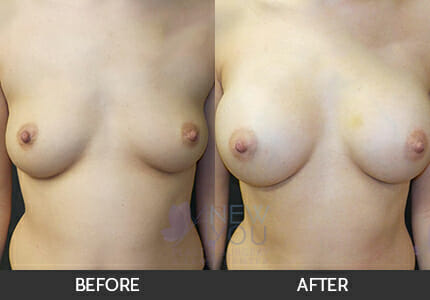 Breast Augmentation Gallery