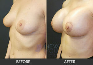 Breast Lift with Augmentation Before and After, Chicago, IL