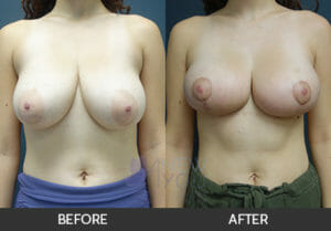 Breast Lift Before and After, Chicago, IL