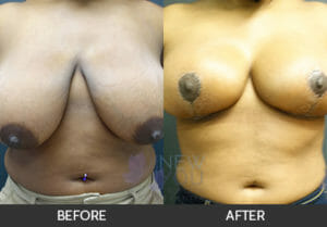 Breast Reduction Before and After, Chicago, IL