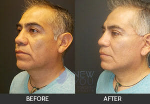 Male Facelift Before and After, Chicago, IL
