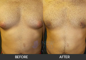 Gynecomastia Before and After, Chicago, IL