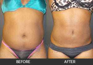 Liposuction Before and After, Chicago, IL