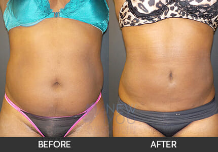 Liposuction Gallery