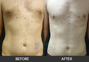 Liposuction Before and After, Chicago, IL