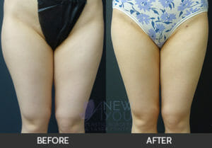 Liposuction Before and After, Chicago, IL