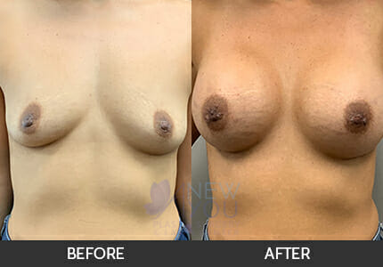 Breast Augmentation Gallery