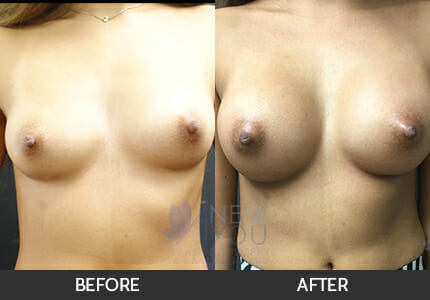 Breast Augmentation Gallery