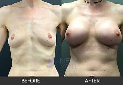 Breast Augmentation Gallery