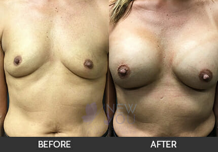 Breast Augmentation Gallery