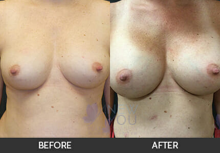 Breast Augmentation Gallery