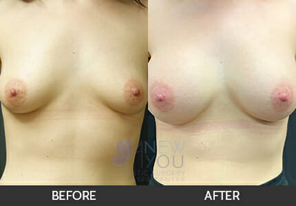 Breast Augmentation Gallery