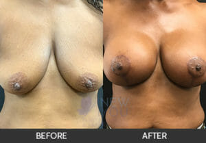 Breast Lift with Augmentation Before and After, Chicago, IL