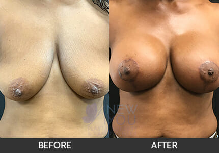 Breast Augmentation with Lift (Mastopexy) Gallery