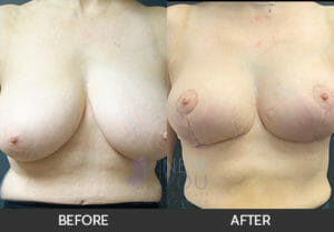Breast Reduction Before and After, Chicago, IL