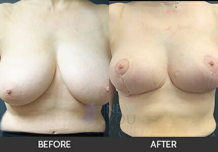 Breast Reduction Gallery