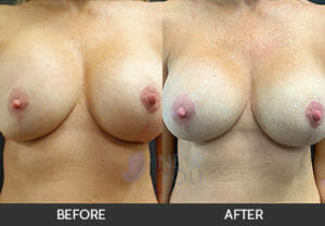 Breast Revision Before and After, Chicago, IL