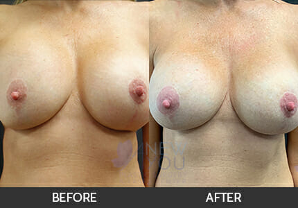 Breast Revision Gallery