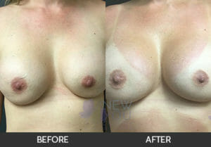 Breast Revision Before and After, Chicago, IL