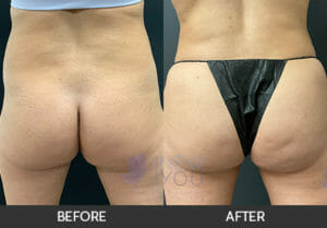 Brazilian Butt Lift Before and After, Chicago, IL