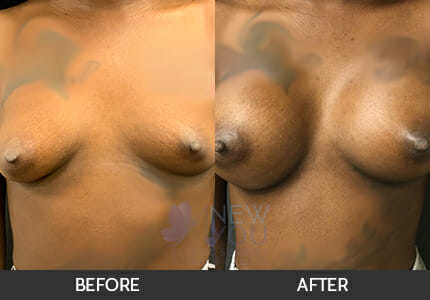 Breast Augmentation Gallery