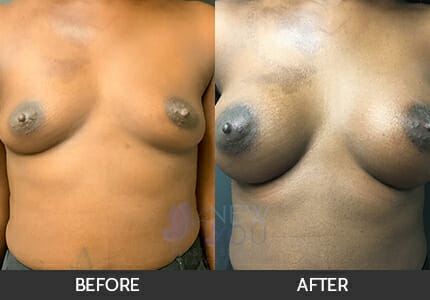 Breast Augmentation Gallery