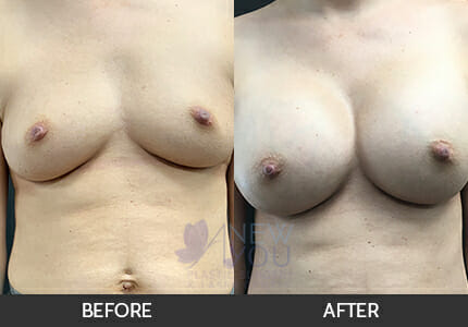 Breast Augmentation Gallery